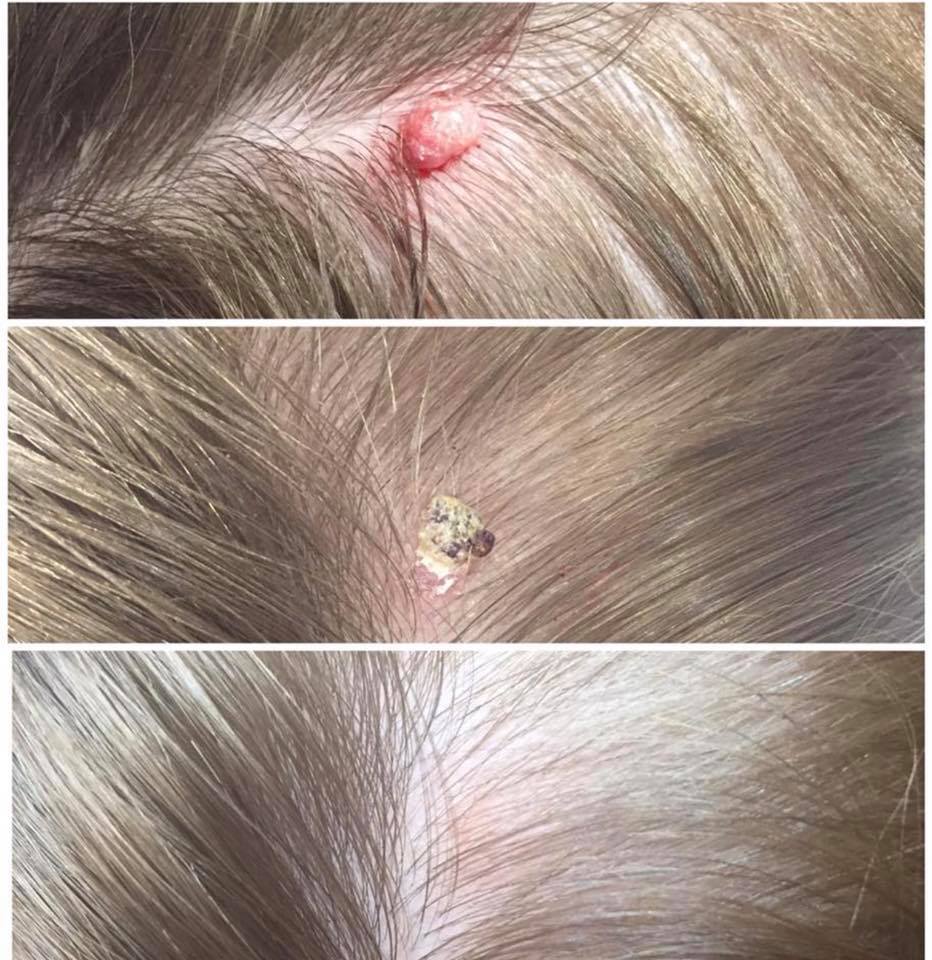Wart on scalp before and after two cryotherapy sessions — Shell Davis